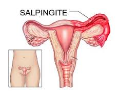 salpingite1
