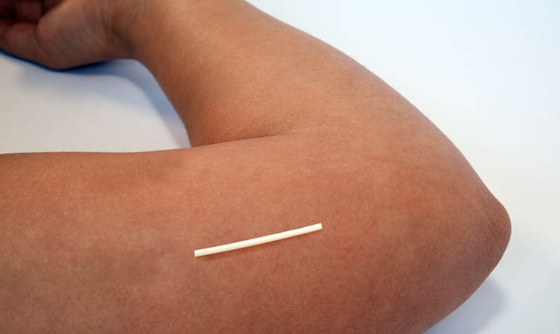 [Santé] Implant contraceptif, on l&rsquo;adopte ? Tout savoir sur cette méthode de contraception